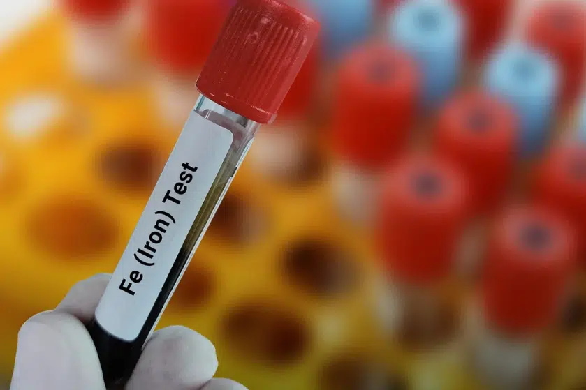 dzelzs deficīta anēmija